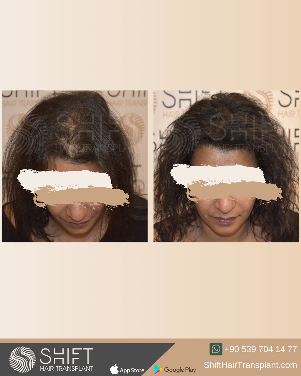 shifthairtr's tweet image. Before and after scalp micropigmetnation for women to get a density camouflage in Istanbul with SHIFT Hair in Turkey

#scalpmicropigmentation #micropigmentation #smp #hairtattoo #hairshading #micropigmentationturkey #micropigmentationistanbul #micropigmentationinturkey
