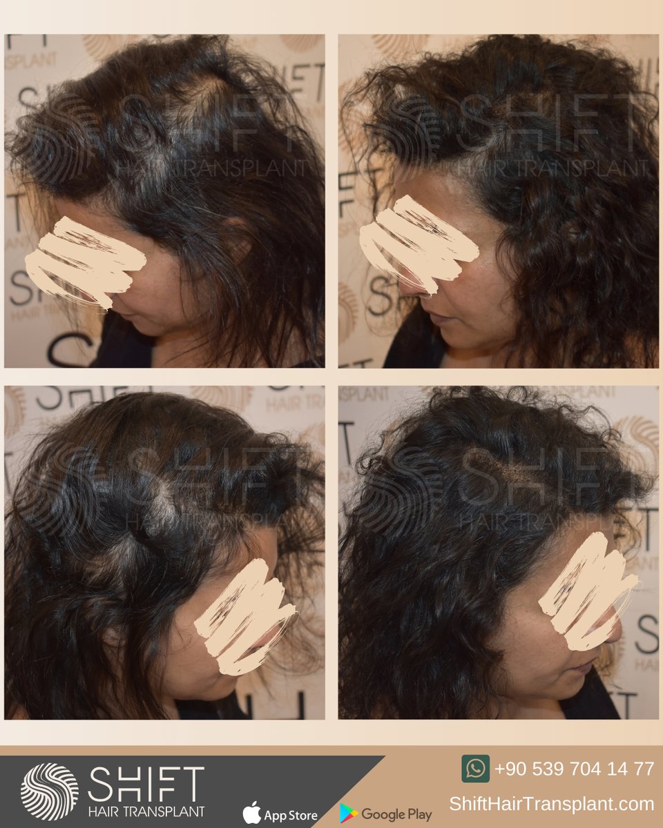 shifthairtr's tweet image. Before and after scalp micropigmetnation for women to get a density camouflage in Istanbul with SHIFT Hair in Turkey

#scalpmicropigmentation #micropigmentation #smp #hairtattoo #hairshading #micropigmentationturkey #micropigmentationistanbul #micropigmentationinturkey