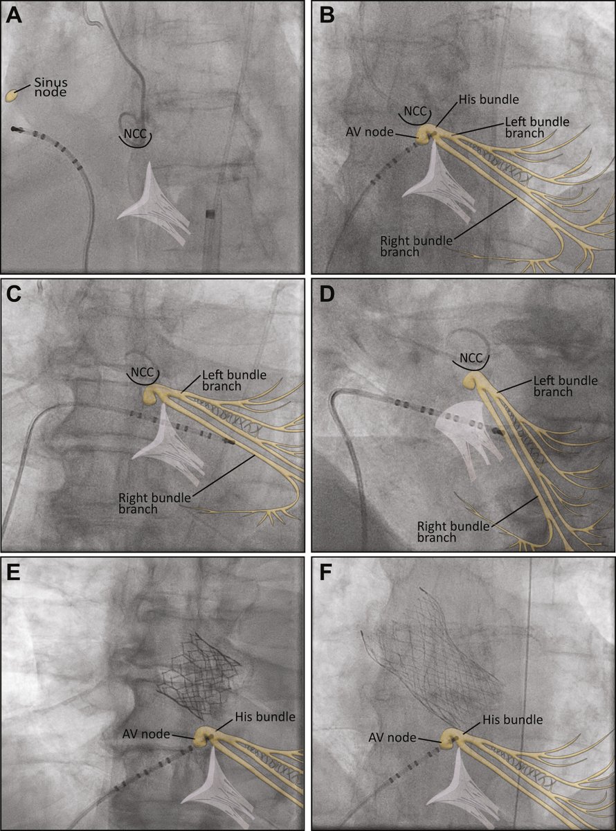 JACCJournals's tweet photo. In this prospective pilot study, Dr. @MarieF_Poulin, et al. examined the safety &amp; feasibility of incorporating routine EP studies performed by #TAVR operators to assess atrioventricular conduction during TAVR procedures. https://t.co/g26R10z1nv #JACCINT #EPeeps https://t.co/BaaUqhhQZI