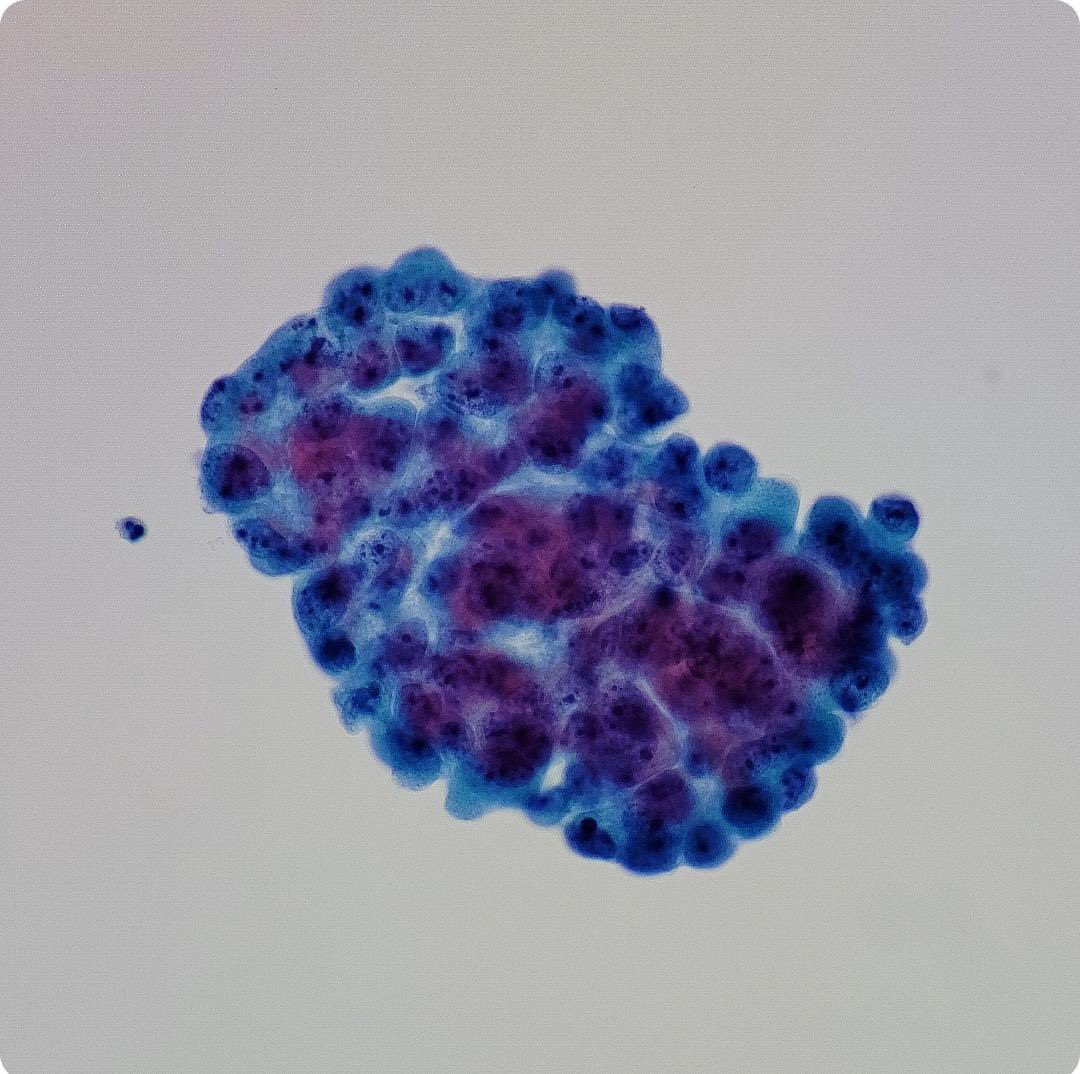 erisadoc's tweet photo. Case of the day 
66 year-old male . 
Urine cytology - TCC https://t.co/w18e9K4LWQ
