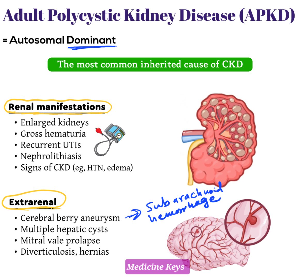 Medicine_keys's tweet photo. Renal and extra renal manifestations of adult polycystic kidney. From, https://t.co/sSGq8uWFNf https://t.co/wx7a8x1mhB