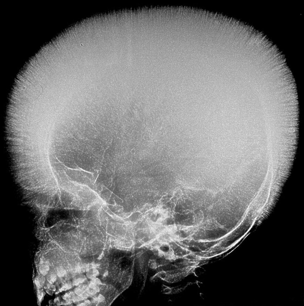 Hair-on-end appearance of the skull is usually seen in patients with thalassaemia and sickle cell anaemia due to chronic haemolysis. It results from accentuated vertical trabeculae between the inner and outer tables of the skull because of excessive bone marrow hyperplasia.