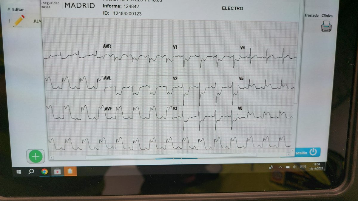 ChGM112's tweet photo. Sabes interpretar un ECG? 
La 1a imágen nos informa de un Infarto Agudo de Miocardio con Elevación del Segmento ST (SCACEST), extenso, InferoPosteroLateral que afecta al Ventriculo Dcho. https://t.co/2QQCwMxNEs