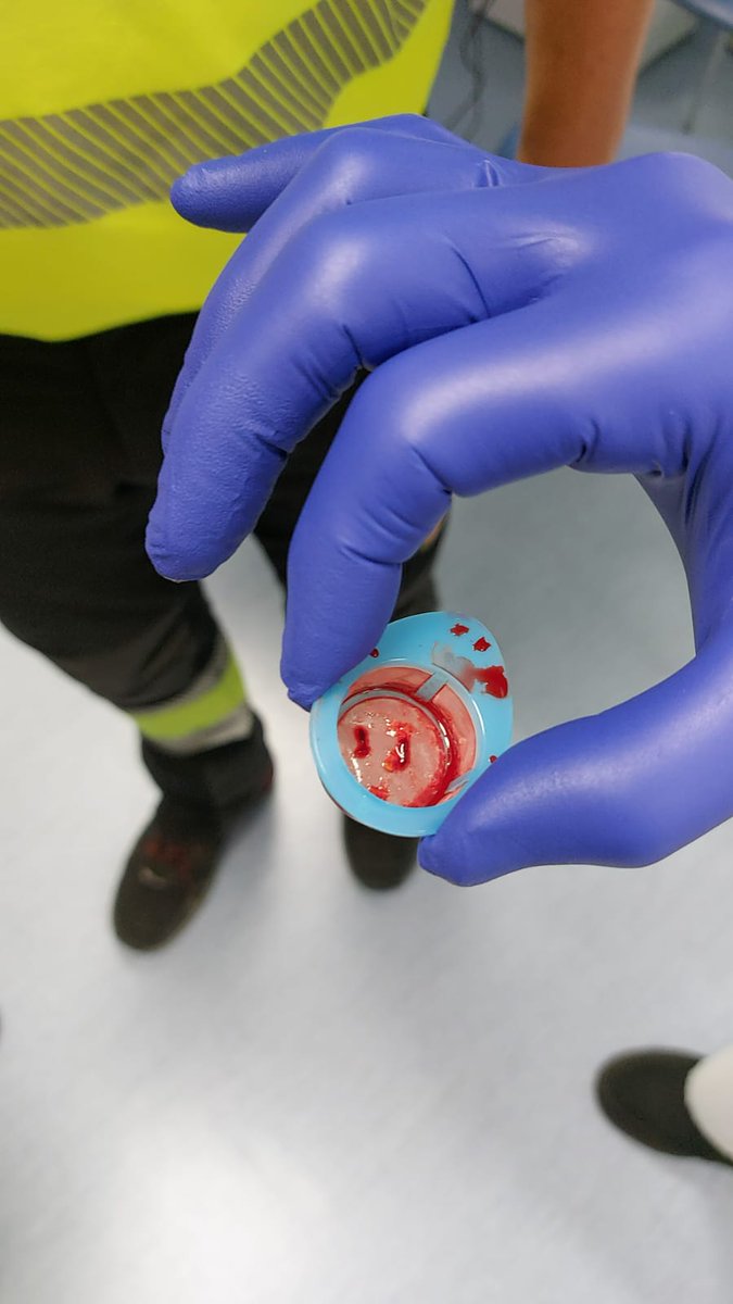 ChGM112's tweet photo. El SCACEST se debe a una obstrucción de una de las Arterias Coronarias que llevan sangre oxigenada al músculo y se produce por unos trombos que vemos en la 2a imágen. Cosa tan insignificante que mata a muchas personas cada año en todo el mundo. https://t.co/wGB9rmsZyf