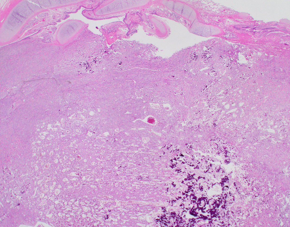 JMcMahonG's tweet photo. Conventional osteosarcoma is an aggressive high-grade bone producing sarcoma. The lungs are the most frequent site of metastatic disease.

 #BSTPath #osteosarcoma #sarcoma #pathology https://t.co/Yu1OqUZJ1n