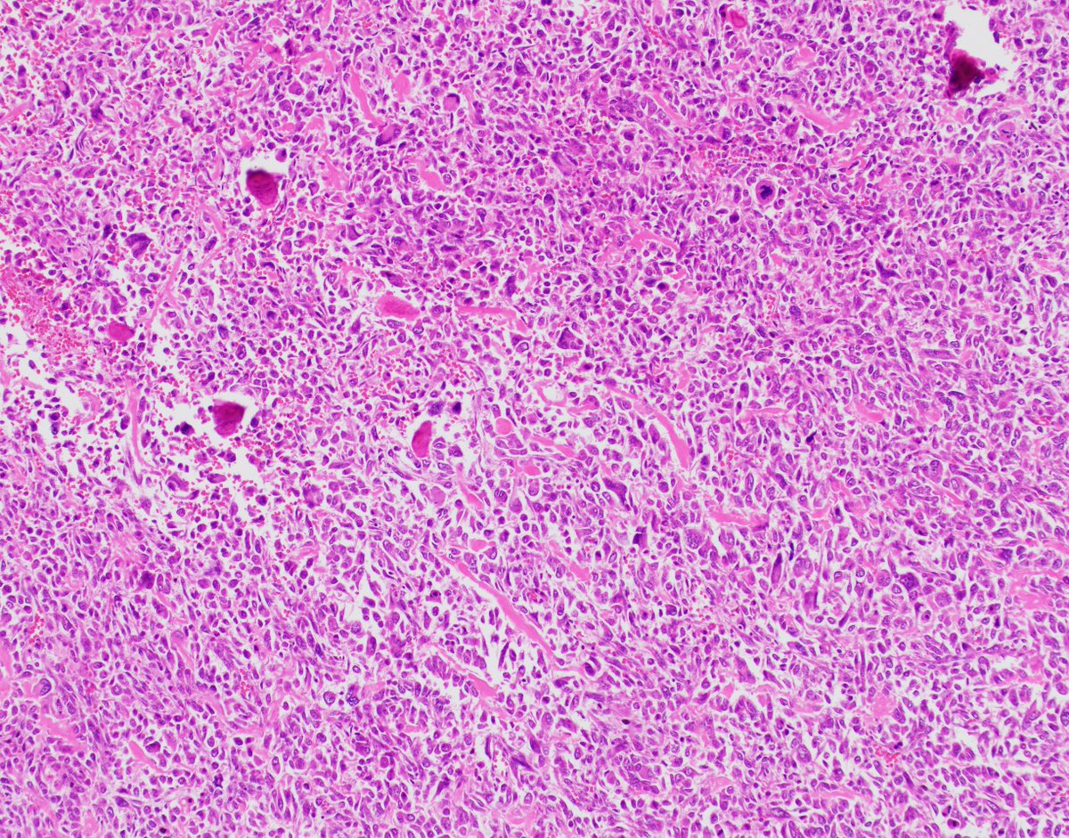 JMcMahonG's tweet photo. Conventional osteosarcoma is an aggressive high-grade bone producing sarcoma. The lungs are the most frequent site of metastatic disease.

 #BSTPath #osteosarcoma #sarcoma #pathology https://t.co/Yu1OqUZJ1n