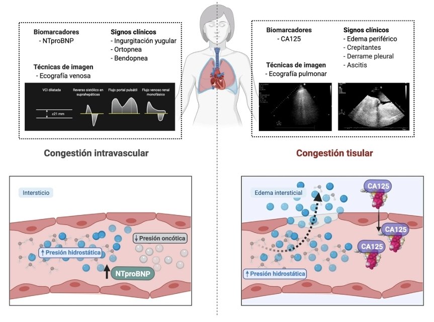 LeslieMegom's tweet image. 🔰Una excelente revisión 🫀💧Congestión e inflamación 💥⬆️en la insuficiencia cardíaca🫀: Cuantificación y tratamiento💊 de la congestión en insuficiencia cardíaca: una visión clínica y fisiopatológica.💧
👇👇👇👇👇
revistanefrologia.com/es-cuantificac…
🗝🔒
acrobat.adobe.com/link/track?uri…
