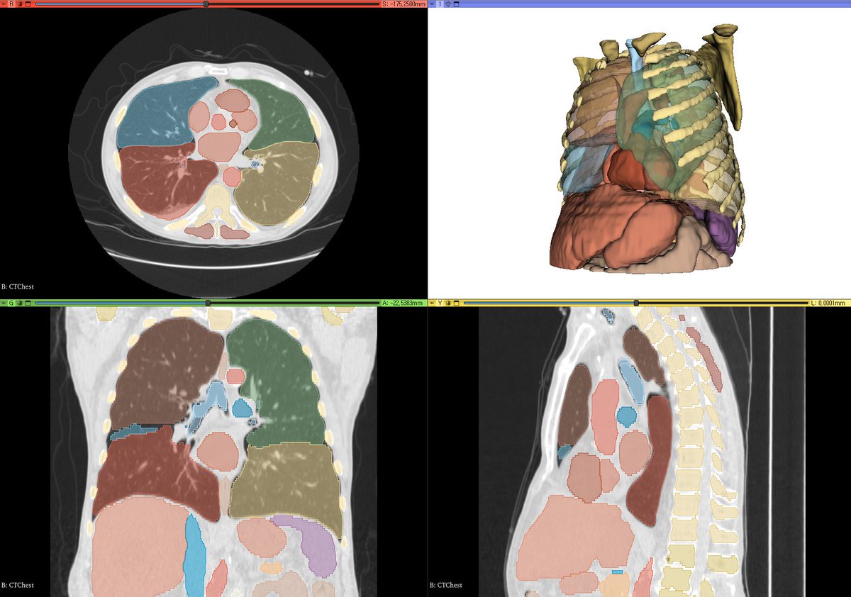 #3dslicer is getting better and better with #totalsegmentator and #ai #lung #autosegmentation
#3d #anatomy #medicalimage