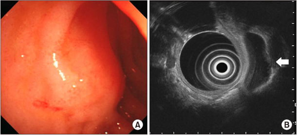 tmhamed's tweet photo. @ScopingSundays @GowthamiR01 @EHolzwanger @BilalMohammadMD @AhmadBazarbashi @CarlKayMD @vaibhav_manu @RobertoSimonsMD @JosephHabibi_MD @AdvaniRashmiMD @TrieuMD @LizzieAbyMD @rmulkimd Performing EUS for SELs: Confirm endoscopic location of lesion and then evaluate with EUS
Decipher between intramural lesion vs. extrinsic compression
#ScopingSunday #GITwitter https://t.co/xzwTbwTydB