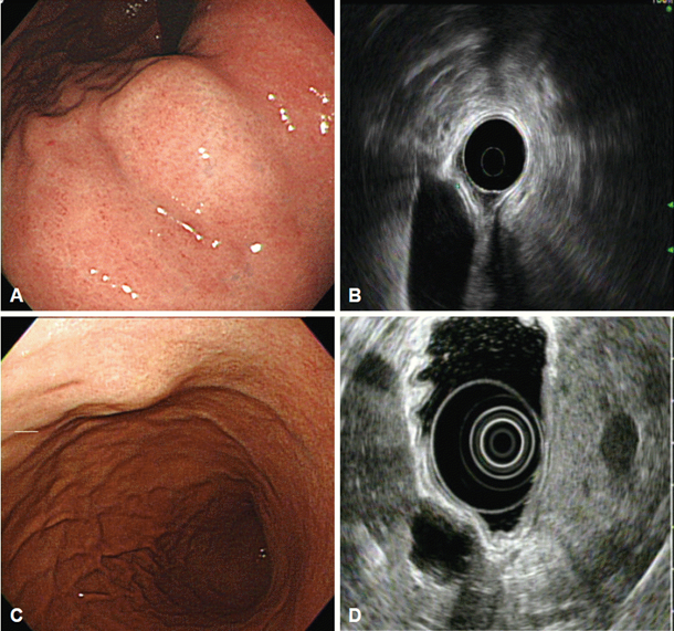 tmhamed's tweet photo. @ScopingSundays @GowthamiR01 @EHolzwanger @BilalMohammadMD @AhmadBazarbashi @CarlKayMD @vaibhav_manu @RobertoSimonsMD @JosephHabibi_MD @AdvaniRashmiMD @TrieuMD @LizzieAbyMD @rmulkimd @ShimaghavimiMD @pritesh_mutha @drkeithsiau @SChandanMD @EndoscopyOthman @buxbaum_l @ChahalPrabhleen @drKumarGI @AnandSahaiEUS Changing a patient’s position can help shift the position of adjacent organs (such as the liver) to assess for extrinsic compression, leading to the false appearance of a true intramural SEL.
#ScopingSunday #GITwitter https://t.co/Ph5nkJ8sMw