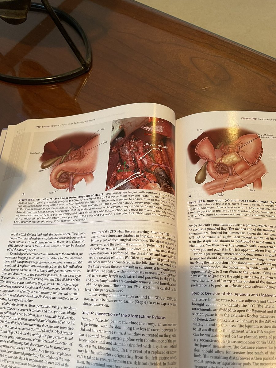 Honored that our group wrote the pancreaticoduodenectomy and total pancreatectomy chapter for the new edition of Mastery of Surgery. Even more special since this chapter was written by my mentor in the last few editions @GregWilson152 #sameerpatel @UCincyMedicine @UCincySurg
