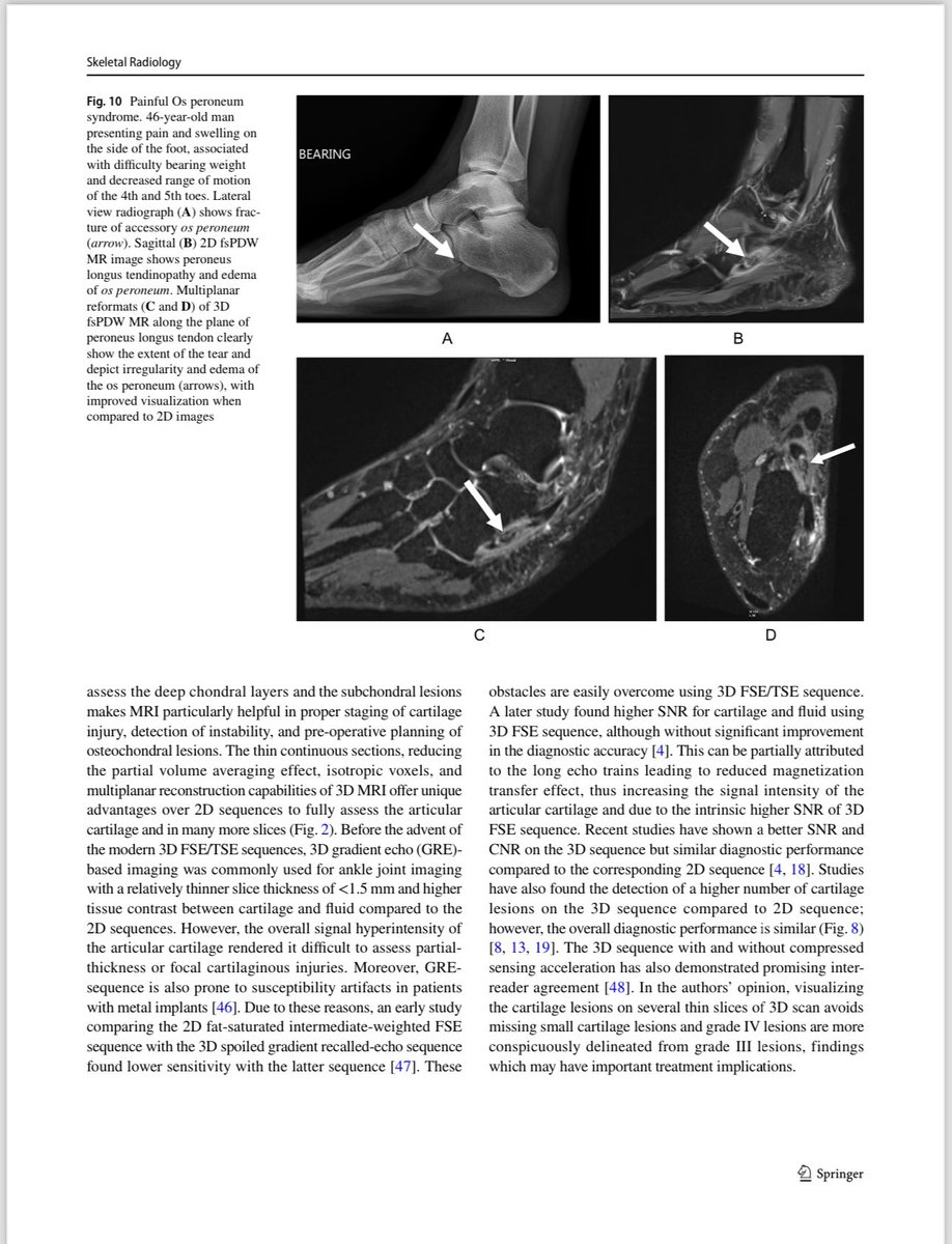 Our paper on “3D MRI of the Ankle” is now available online at Skeletal Radiology (IF: 2.1)! 🦶🏼Enjoy free PDF at rdcu.be/drsdV 🔗 W/ @AChhabraMD @bajaj_MD @ivpedrosa @Brewington_UTSW @leyendecker_rad #radres #mskrad #radiology #mskradiology #ankle #mri