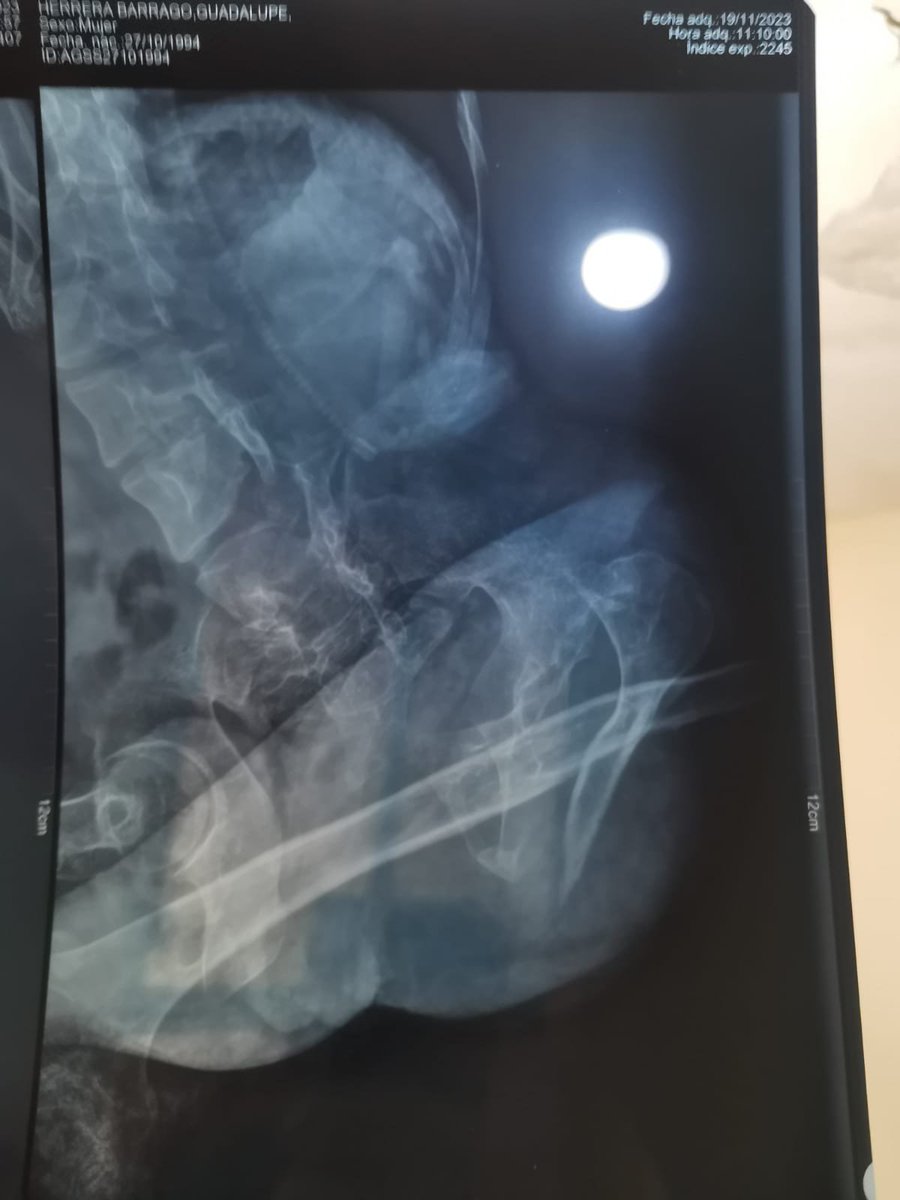 ghcreativa's tweet photo. Me da mucha pena hacer esto. Pero nadie ha muerto por pedir apoyo. Me fracture el femur por tercera vez y necesito una operacion cuyo coste es aproximadamente 60-70k
incluso un peso es bueno, les agradezco, prometo regresarlo de una o otra manera. https://t.co/iO5Ovyhy4e https://t.co/kHkQl77LpD