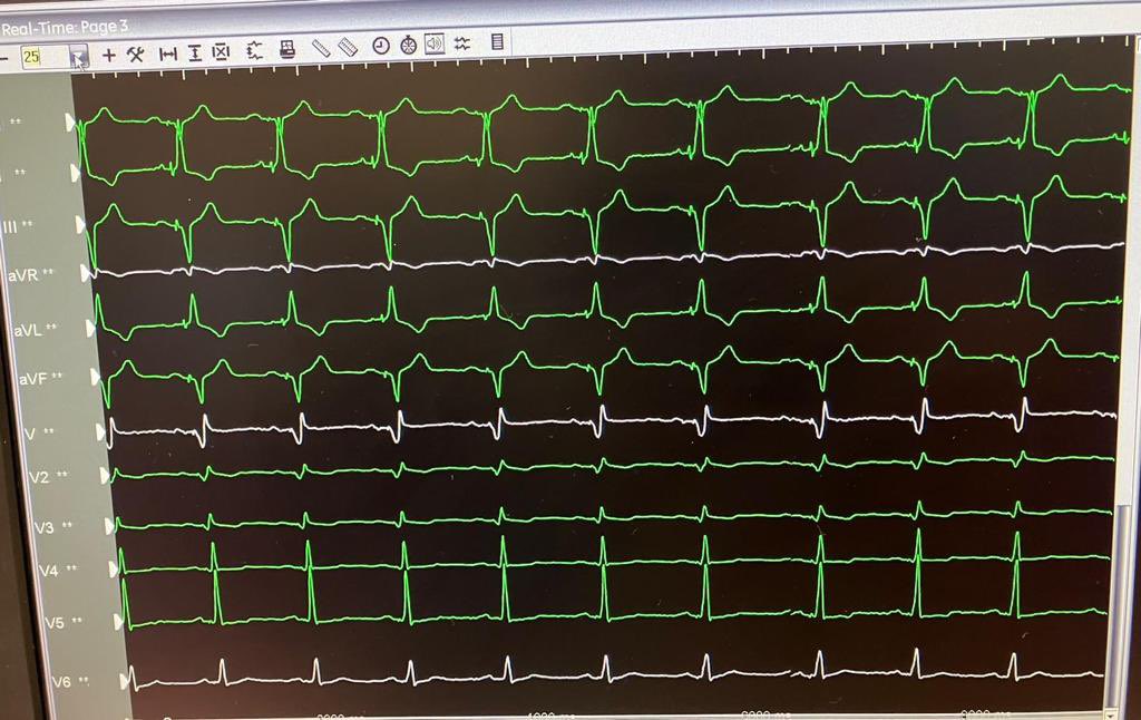 JustinHalligan's tweet photo. Celebrating a pivotal moment in cardiac care as we implant the first #AmviaSky #Biotronik pacemaker, the worlds first pacemaker approved for left bundle branch area pacing #Leftbundlebranchpacing in UK/IRE at @Beaumont_Dublin @Biotronik_UK @ZS279 https://t.co/S0PhSGEFQP