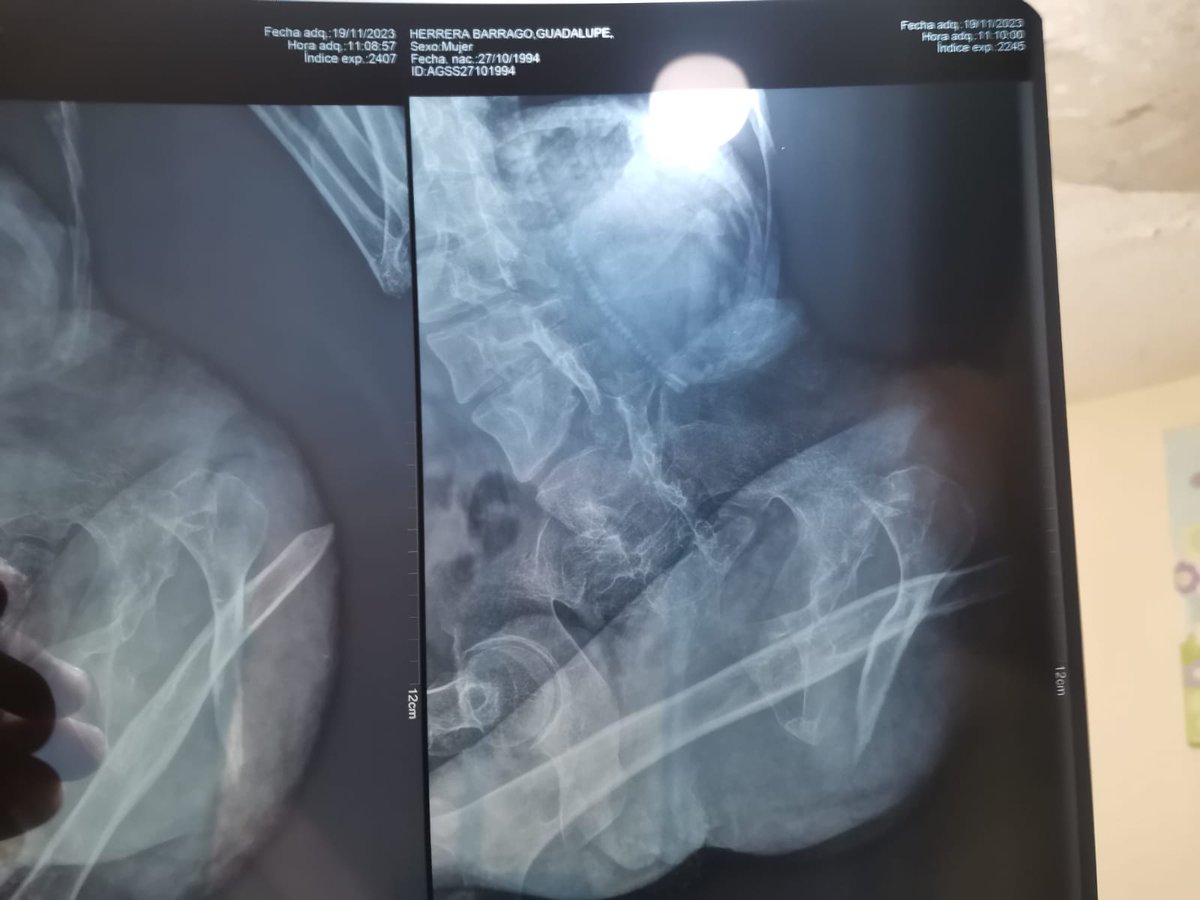 ghcreativa's tweet photo. I am very sorry to do this. But no one has died for asking for support. I fracture my femur for the third time and need an operation which costs approximately 2-4k

Even a dolar is good, I thank you, I promise to return it one way or another.

https://t.co/iO5Ovyi5TM https://t.co/BRpX39hnYo