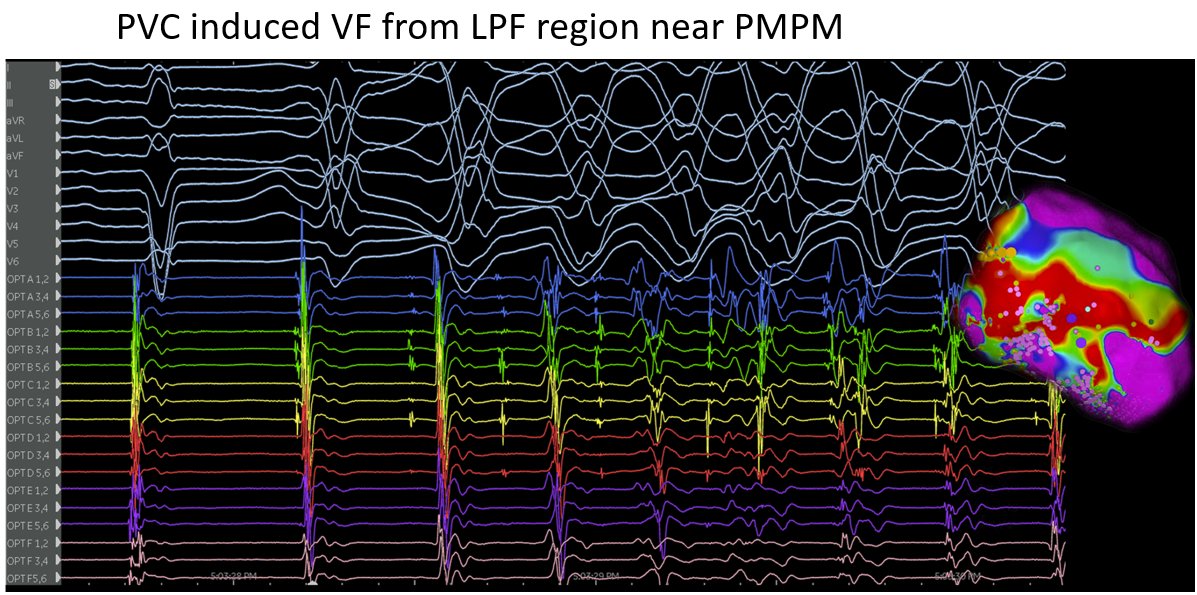 PennEPFellows's tweet photo. #Epeeps Always look at initiation of VF - maybe you can find a trigger!! Common sites include LPF and near moderator band. 
Slides borrowed from @Dr_Santangeli 
@PennCardiology 
@GustavoSGuanda @Stephen_Keane1  @MichaelGurinMD https://t.co/1jEWprgVWB