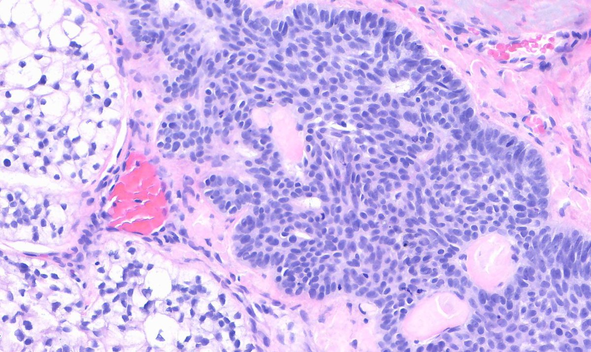 STEVENKOLKERMD's tweet photo. Clear cell basal cell carcinoma https://t.co/tJKgNPDxl7