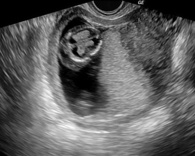 BrownJHM's tweet photo. A 25 year old primigravida presented for routine ultrasound. TORCH test was positive. What findings are noticed/likely diagnosis? (Image @Radiopaedia, case by Maulik S Patel) #medEd https://t.co/XFJy5FDbnT