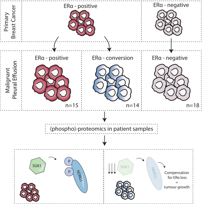 🗞️Available to read online! Proteomics on malignant pleural effusions reveals ERα loss in metastatic breast cancer associates with SGK1–NDRG1 deregulation 🔓buff.ly/3R7voNZ @wesseling64 #BCSM #Proteomics #ERα #Metastasis