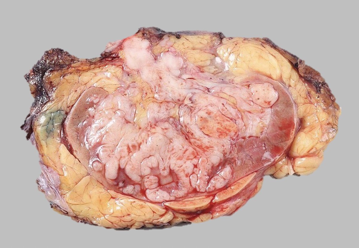 #macrovsmicro radical nephrectomy, sarcomatoid components comprise sizeable areas displaying dense, tan-pink, or white areas within the tumor, typically with a firm and fleshy texture on cut surface #gupath #pathtwitter #kidneytumor