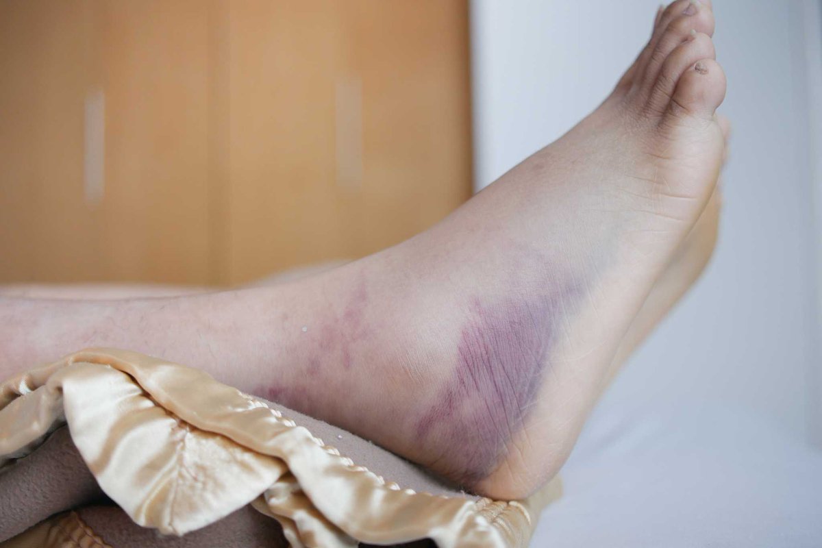 BurlingtonFoot's tweet photo. Diabetes won't hold you back with proper foot care. Rely on Burlington County Foot &amp; Ankle Associates for expert guidance and proactive solutions. #DiabetesCare #FootHealth
https://t.co/fzQMnYNLy7 https://t.co/DDeuWa2gnj