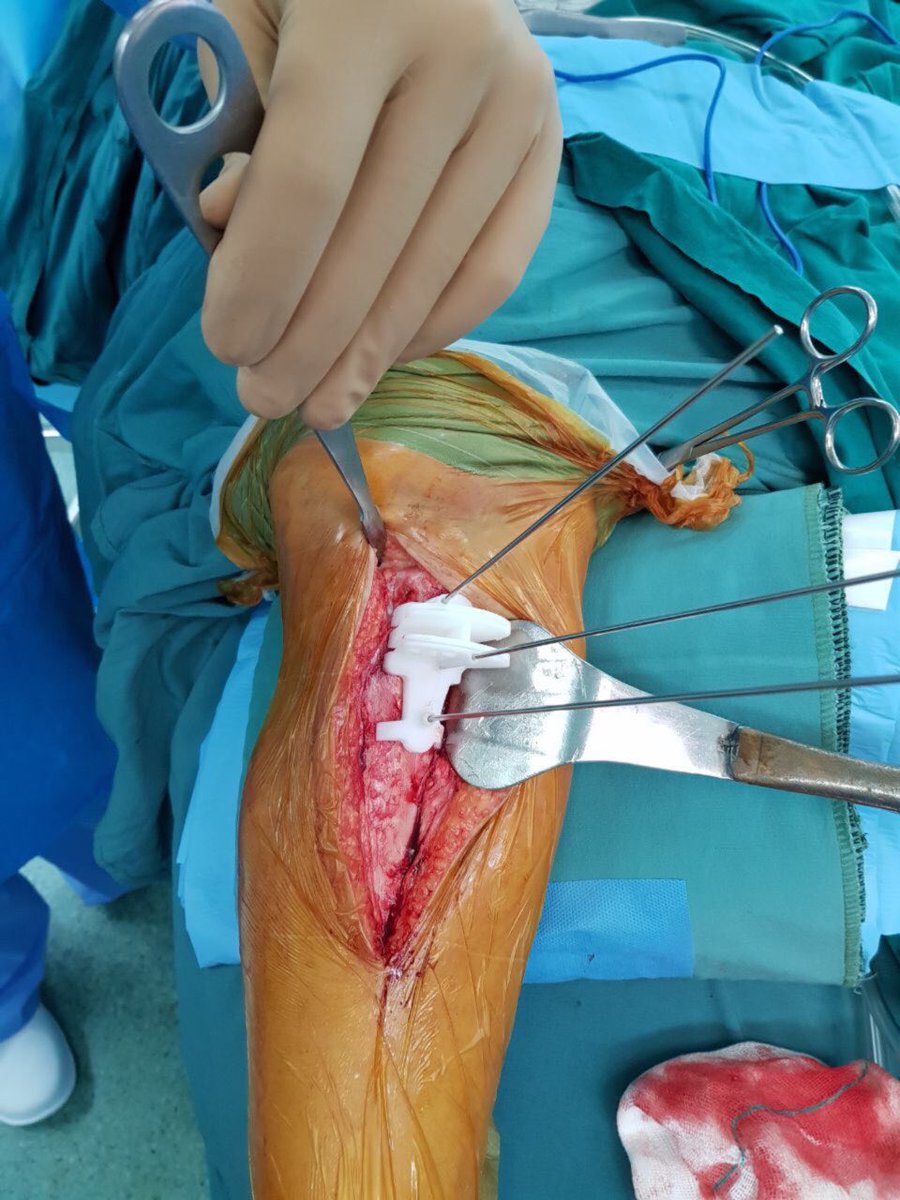 soheilmehdipoor's tweet image. Using a Patient specific guide makes your plan done perfectly.#3dprinted #psi #psguide #3dmodeling #3Dprinting #osteotomy