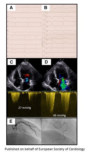 Dynamic mitral regurgitation caused by exercise-induced left bundle branch abnormality and unmasked by isometric handgrip testing bit.ly/40MIbsb

#EHJCaseReports <a href="/aayshacader/">Aaysha Cader</a> <a href="/ANazmiCalik/">A.Nazmi Calik</a> <a href="/TJ_Yeo/">Tee Joo YEO</a> <a href="/Phiso_de/">Philipp Sommer</a> <a href="/EHJCREiC/">EHJCaseReports Editor-in-Chief</a> #CardioX #echofirst