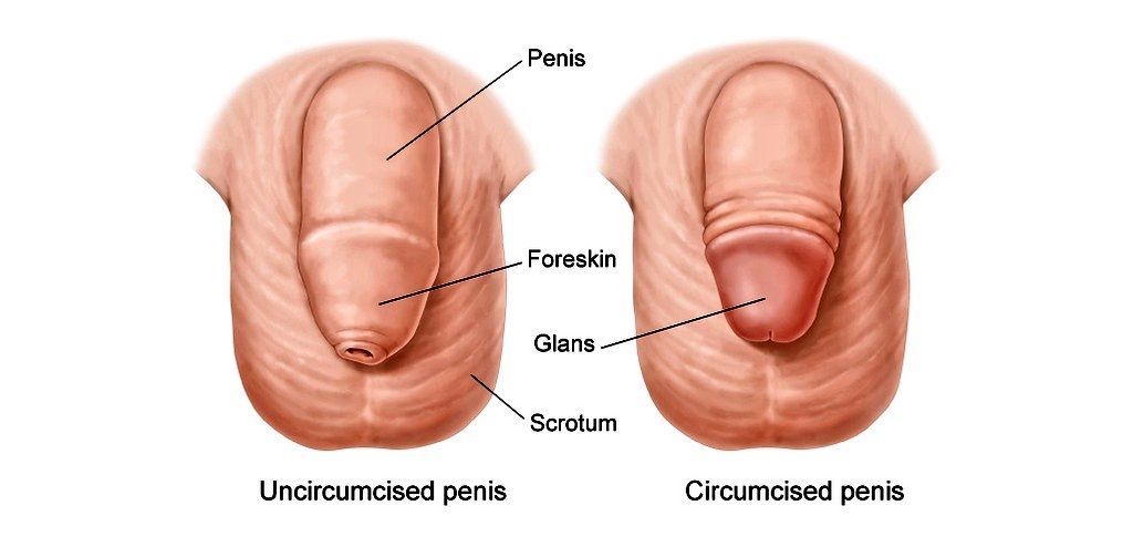 Eric on X: BALANITIS is the 'candidiasis' of men. It is the yeast  infection of the penis, especially a penis that is not circumcised. A  foreskin needs a lot of hygienic and