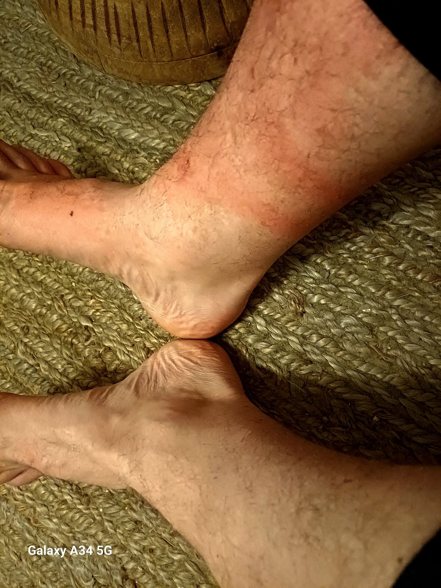 In a hurry few days before rain. Spilt a little bit of clethodim on my jeans. Didn't realise it, nor that it dripped down into my right sock... stayed on for 5 hours. Gott in himmel - that right foot and leg are hurting now, and ugly swelling.