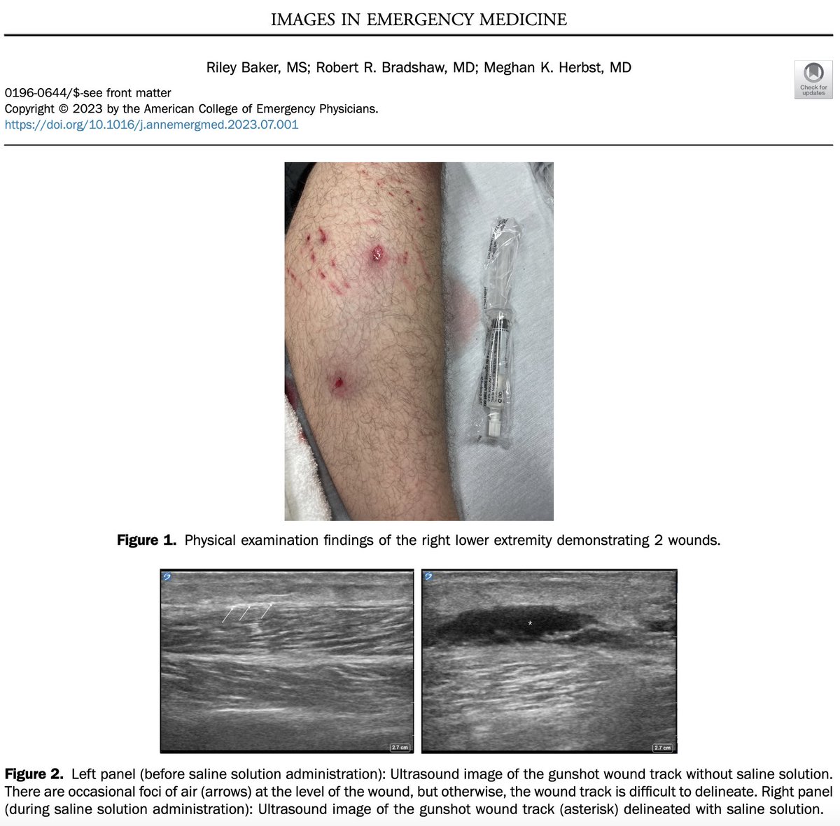 EUSmkh's tweet image. Novel ultrasound application for assessing gunshot wound depth and course: tinyurl.com/y5v62hdx

#raysofgray #POCUS #ultrasound #FOAMed #MedEd #emergencymedicine #medicalstudent #resident