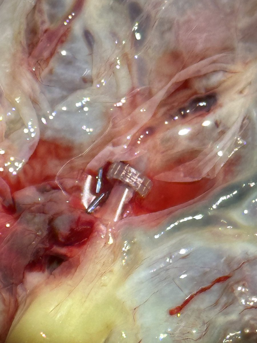 jagdhanda1's tweet photo. What is this? A coupler for microvascular surgery demonstrated on a placenta, a first in the north west of India and the Punjab. Also a first a demonstration of XR and it’s utility in surgical training. #vrims #vrmedicineandsurgery #virtualreality #extendedreality #augmentedreality #mixedreality #VR #AR #XR #medicaleducation
