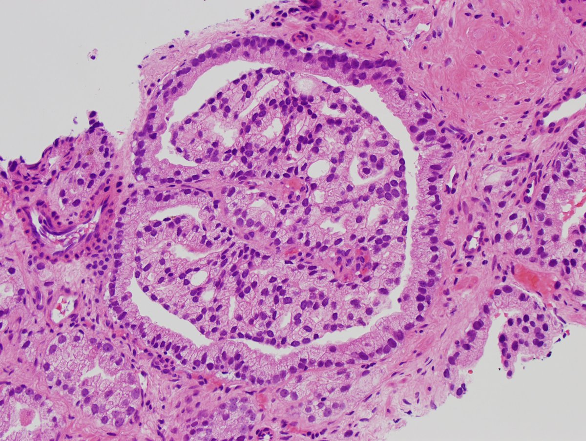 Sometimes you see giant #glomerulus in needle core biopsies. It may not be a sign of diabetes, but rather a sign of Gleason pattern 4 prostate acinar adenocarcinoma. #surgpath #pathX #pathtwitter #pathology #pathologists #gupath #cancer #prostate