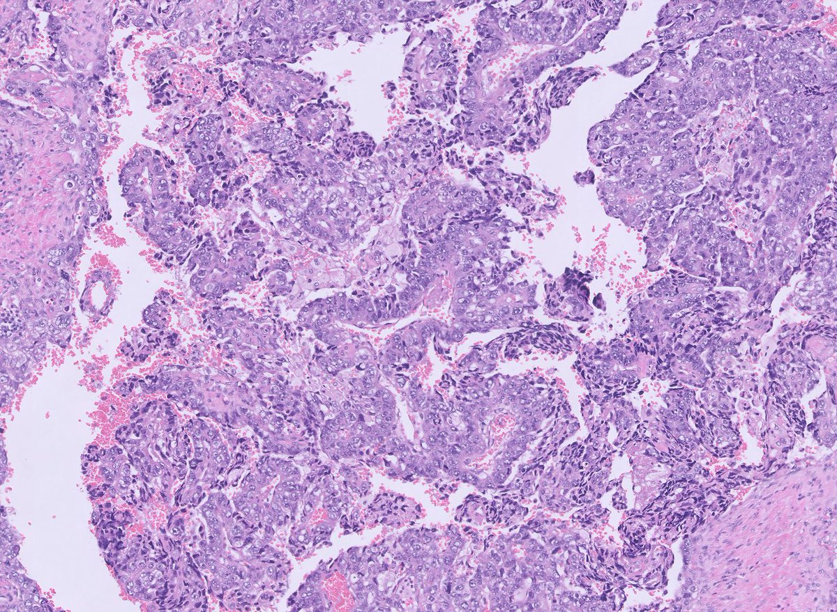 37 y/o M with hx of embryonal carcinoma of testis, now lymph node masses. See WSI, order stains, and check dx here: drdoubleb.com/crowdunknowns/…