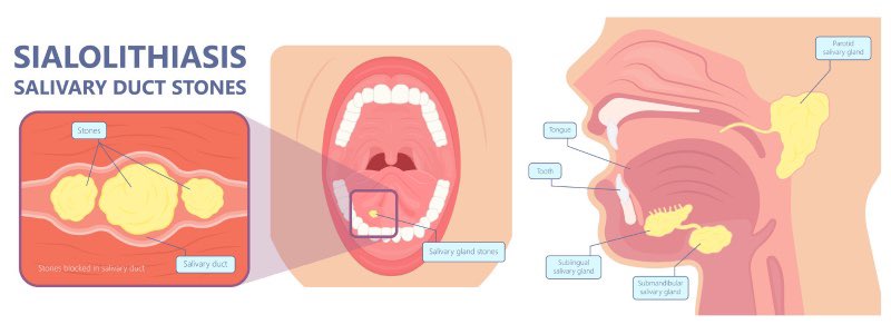 FosterDrugInfo's tweet photo. 🤤#Salivary_Gland Stone (#Sialolithiasis): #Infection
✅Anti #Staphylococcal #Antibiotics e.g:
#Dicloxacillin
#Cephalexin
500mg QID for 7-10 days
✳️If not improved:
Substitute #Amoxicillin/#Clavulanate or #Clindamycin until the results of duct #discharge #culture are available. https://t.co/1eyplqIDDw