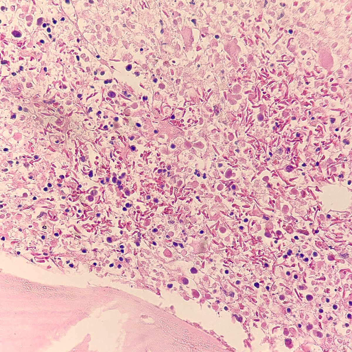23 years old male with body pain, pancytopenia. What do you see?
#MorphologyMonday