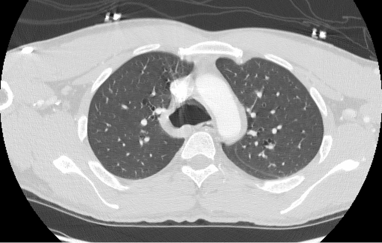 CHEST case of the week:
40M with chronic cough. What's the diagnosis?
#ChestRad #MedEd #radres #futureradres #radiology