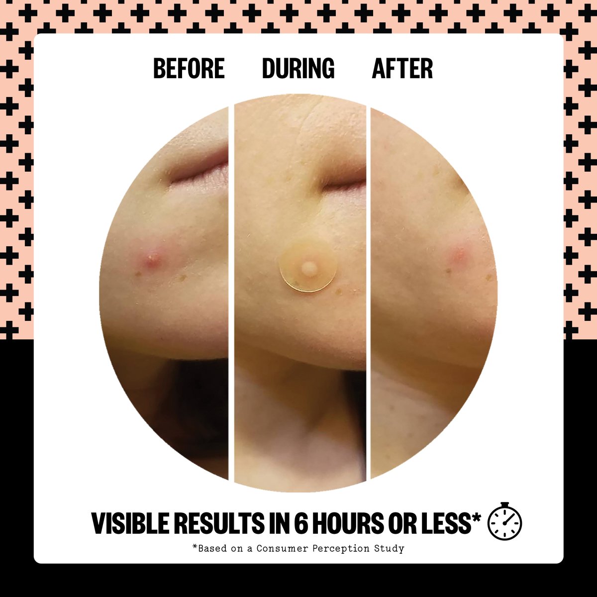 Want a chance for your before &amp; after to be featured?! Be sure to tag @peaceoutskincare &amp; #Zitmergency 😍