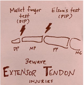 EMNews's tweet photo. #EPs should watch out for #extensor #tendon injuries of the #finger, says @M_Lin, because they can lead to chronic deformities and disability.
Here are some tips to remember. https://t.co/8rc9ibJ2lo #FOAMed https://t.co/FyTX6jy32V