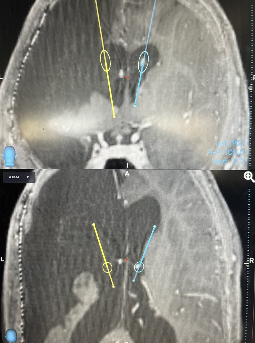 StaudtMD's tweet image. “Interesting” ANT-DBS placement through a giant fluid cavity from an old hemispherectomy, among other surgeries.

“Flapping in the breeze”, you could say. Thank goodness for the at-target cannula. 

#epilepsy #deepbrainstimulation