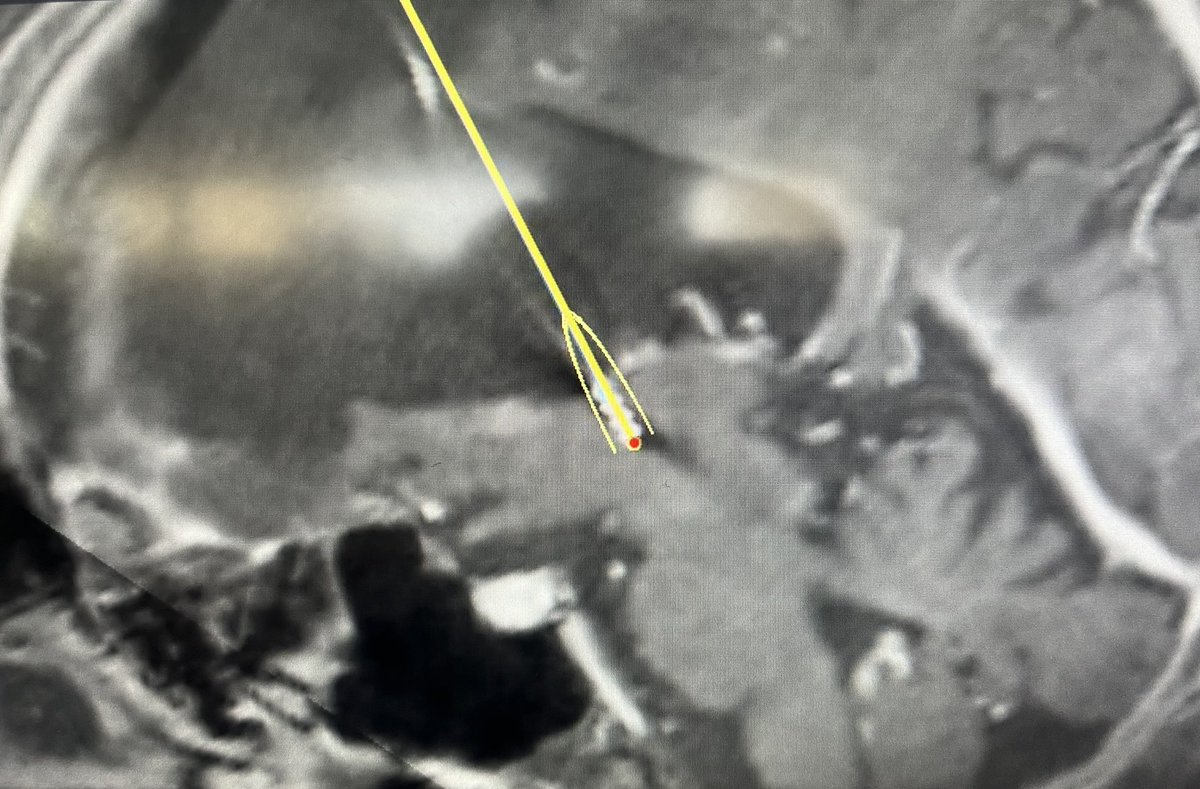 StaudtMD's tweet image. “Interesting” ANT-DBS placement through a giant fluid cavity from an old hemispherectomy, among other surgeries.

“Flapping in the breeze”, you could say. Thank goodness for the at-target cannula. 

#epilepsy #deepbrainstimulation
