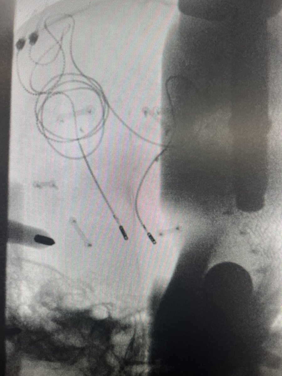 StaudtMD's tweet image. “Interesting” ANT-DBS placement through a giant fluid cavity from an old hemispherectomy, among other surgeries.

“Flapping in the breeze”, you could say. Thank goodness for the at-target cannula. 

#epilepsy #deepbrainstimulation