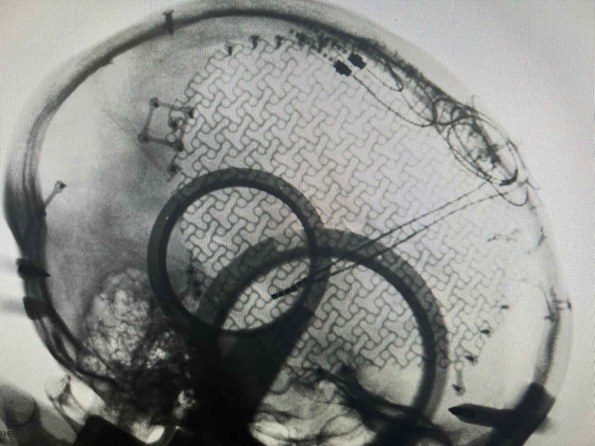 StaudtMD's tweet image. “Interesting” ANT-DBS placement through a giant fluid cavity from an old hemispherectomy, among other surgeries.

“Flapping in the breeze”, you could say. Thank goodness for the at-target cannula. 

#epilepsy #deepbrainstimulation