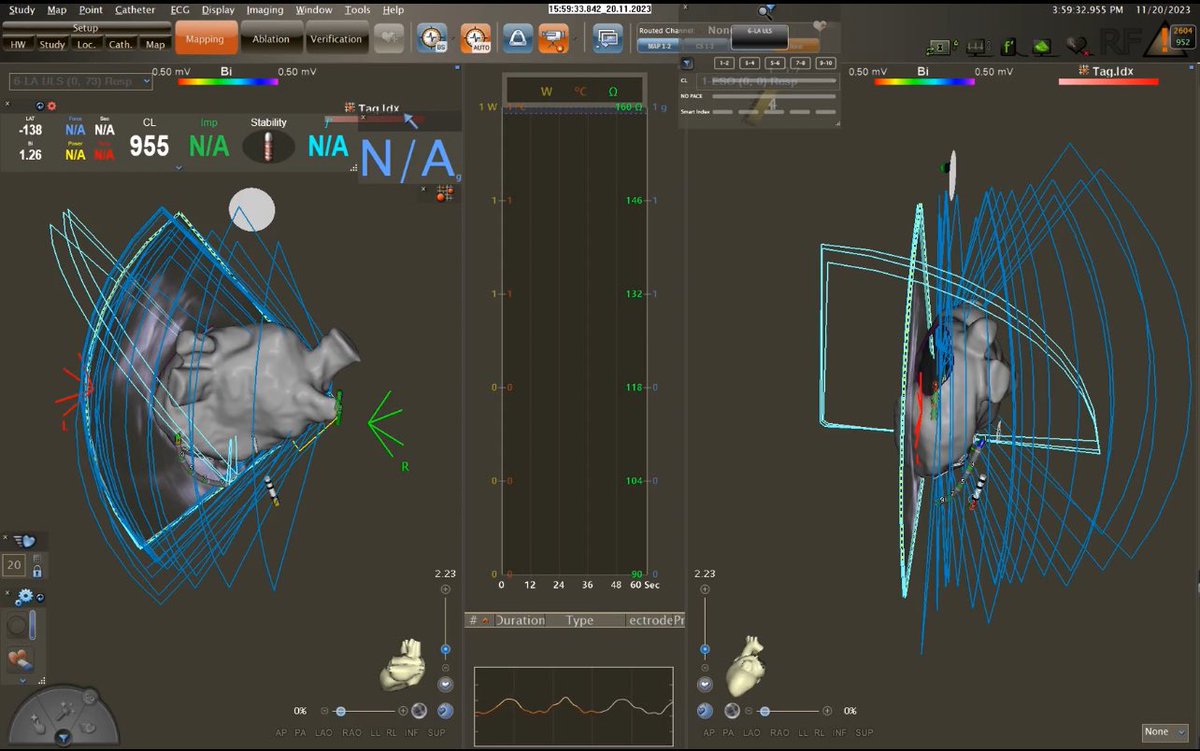 First worldwide use of CARTO 3 V8 system! Just finished a case completely fluoroless in conjunction with QDOT and OCTARAY with prof <a href="/LuigiDiBiaseMD/">Luigi Di Biase</a>. 
<a href="/MonteHeart/">Montefiore Heart</a> , <a href="/MontefioreNYC/">Montefiore Health System</a> <a href="/EinsteinMed/">Albert Einstein College of Medicine - Official</a> , @BiosenseWebster <a href="/GrupposoVito/">Vito Grupposo</a>