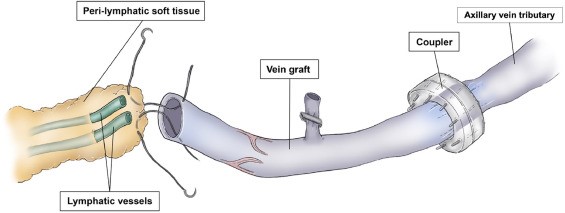 Not only does a lower extremity vein graft improve the success rate of ILR, but it also spares having to use the thoracodorsal vein, which preserves the latissimus flap for future use if needed. #breastcancer #breastsurgery #lymphedema