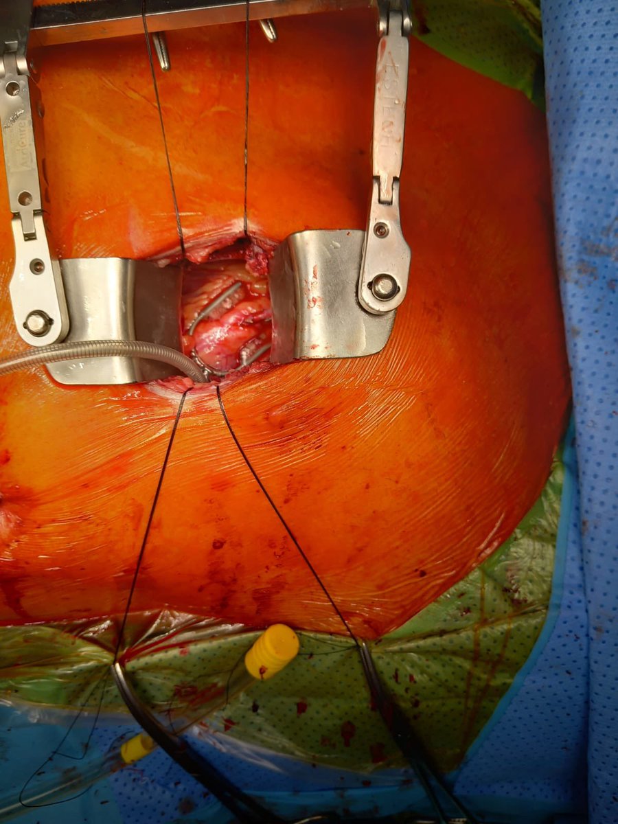GConcistre's tweet photo. Minimally invasive myocardial revascularitation
#midcab #minimallyinvasive #cabg #cardiacsurgery #cardiology
@opa_massa https://t.co/moesrAiHsg