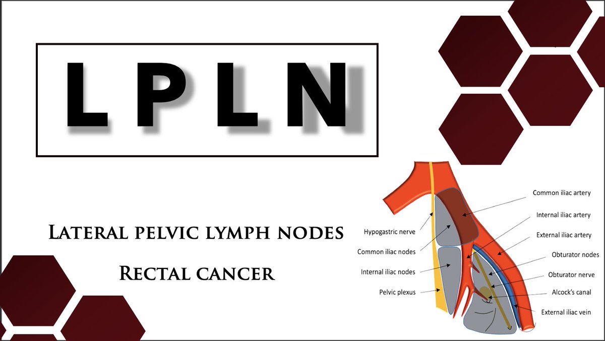 🚨 🚨 🚨 🚨 🚨 🚨 Lateral pelvic lymph nodes (LPLN) in #RectalCancer (RCa)! Should all RCa get LPLND Why is lateral pelvic space a feared anatomical area for clearance Consequences of suboptimal Sx? Does clearing d obturator nodes like in Uro-gyn suffice? 🧵.. #MedTwitter