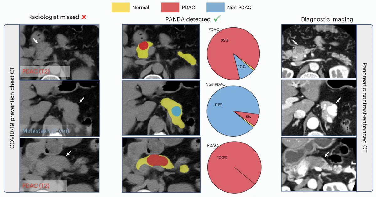 Eric Topol (@erictopol) on Twitter photo A very impressive study for #AI picking up pancreatic cancer from non-contrast CT with 93% sensitivity, 99.9% specificity, AUC ~0.99, including from chest CT scans performed Covid.
nature.com/articles/s4159… <a href="/NatureMedicine/">Nature Medicine</a> A very impressive study for #AI picking up pancreatic cancer from non-contrast CT with 93% sensitivity, 99.9% specificity, AUC ~0.99, including from chest CT scans performed Covid.
nature.com/articles/s4159… <a href="/NatureMedicine/">Nature Medicine</a>