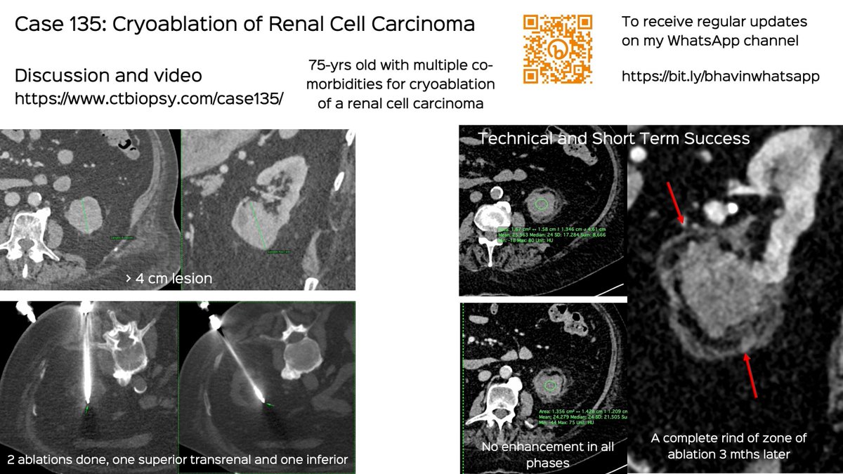 Case 135: Cryoablation of Renal Cell Carcinoma

75-yrs old with a > 4 cm solid renal lesion.

Video and discussion
ctbiopsy.com/case135/

#ctbiopsy #irrad #cryoablation #renalcellcarcinoma #renalcryoablation