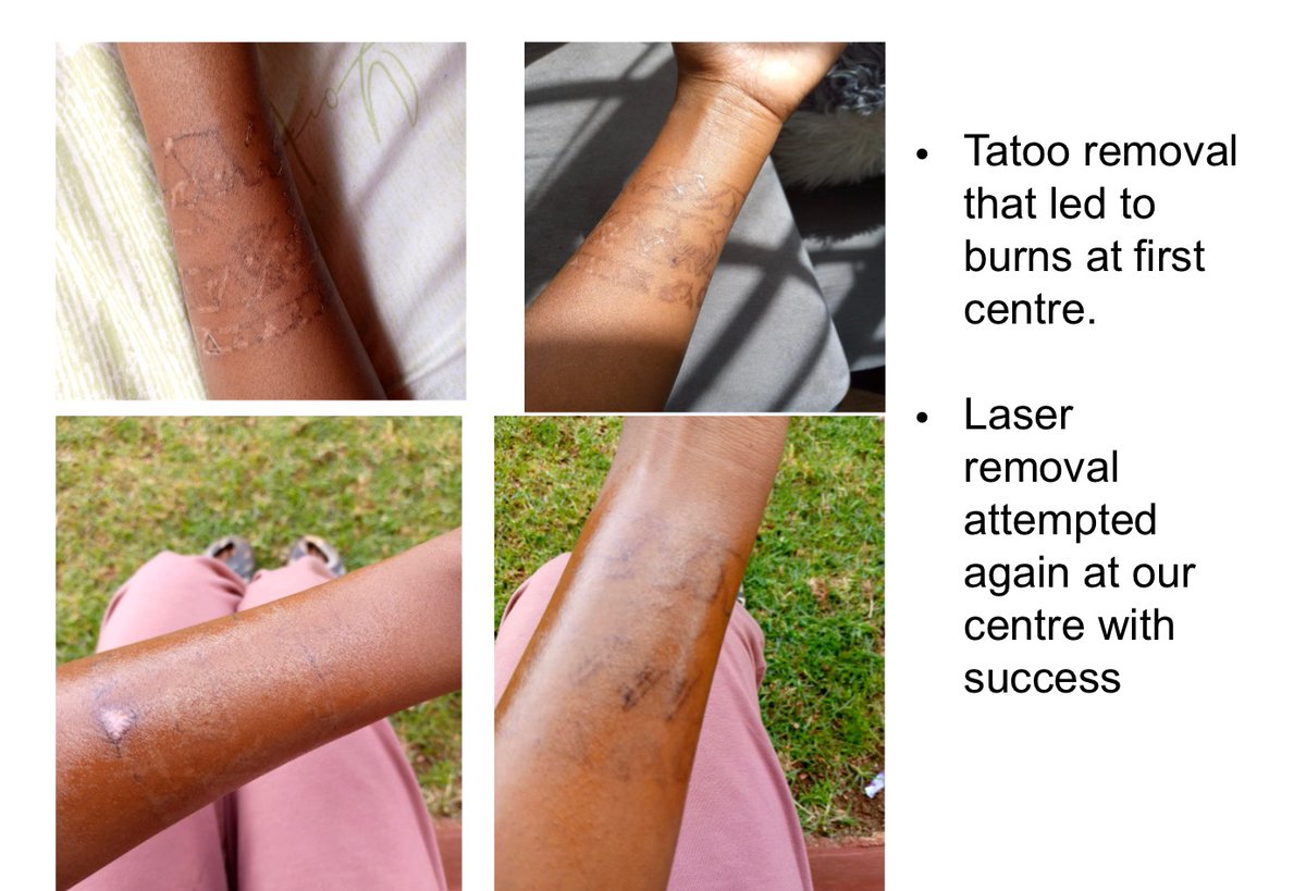 dermatology_ke's tweet photo. Use of lasers in treatment of skin of colour is challenging even to well skilled aestheticians and clinicians. Only a doctor who handles skin of colour frequently can know what to do and how to reverse side effects from lasers #skinlaser https://t.co/CqHZZi8rf4