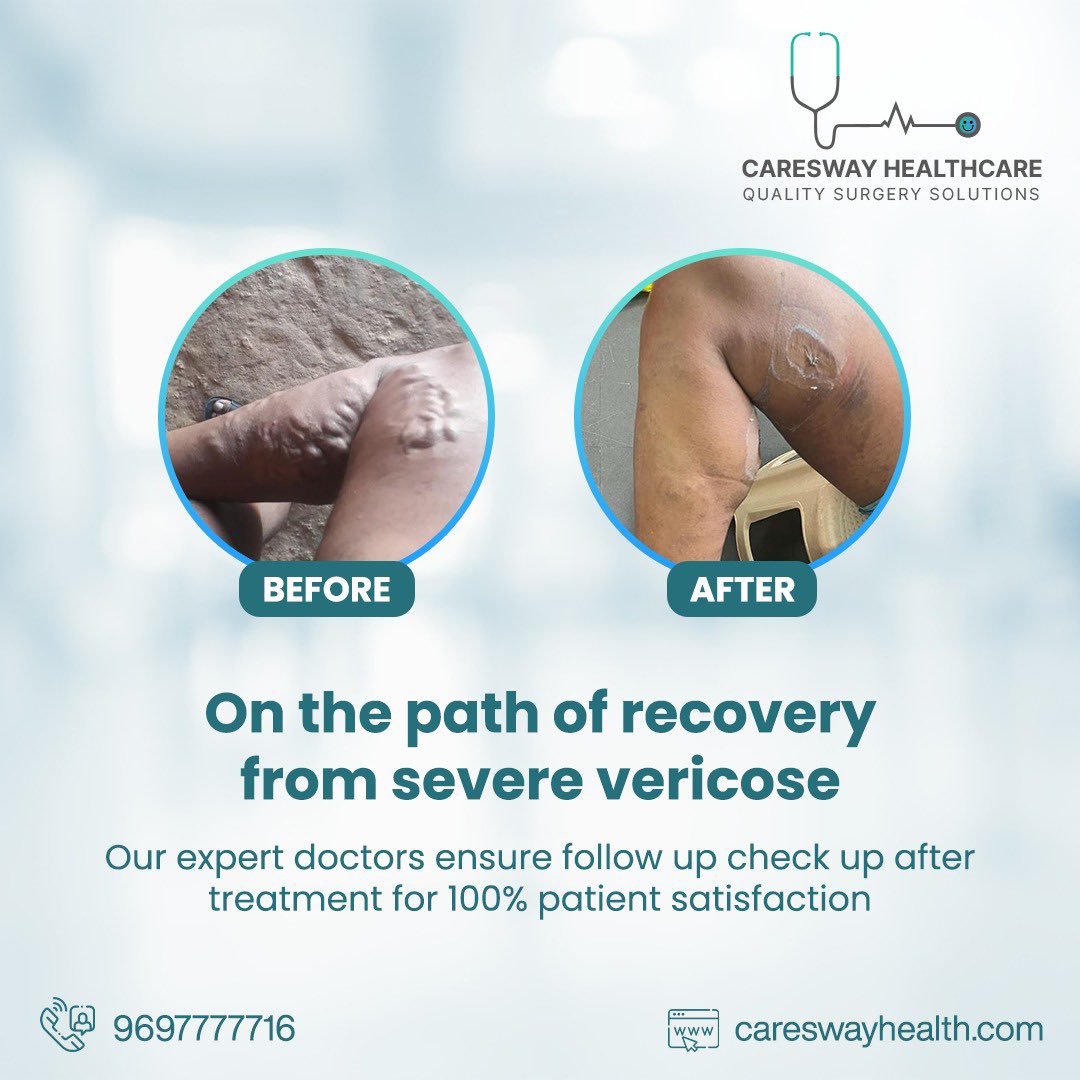 CareswayHealth's tweet photo. On the path of recovery from severe vericose
Our expert doctors ensure follow up check up after treatment for 100% patient satisfaction https://t.co/hcSdodcYx4